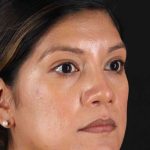 Rhinoplasty Before & After Patient #3181