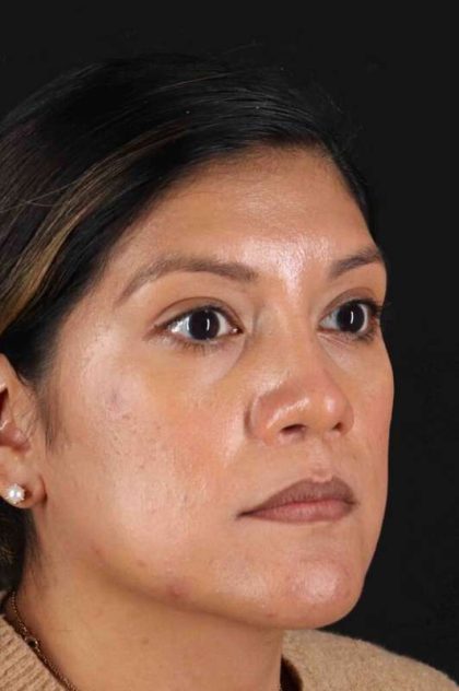Rhinoplasty Before & After Patient #3181