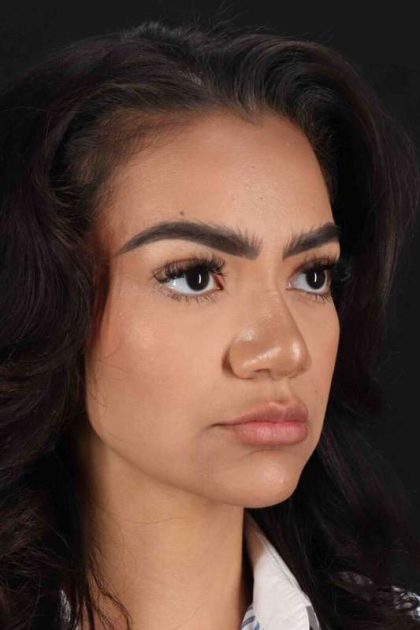 Rhinoplasty Before & After Patient #3192