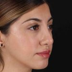 Rhinoplasty Before & After Patient #3214