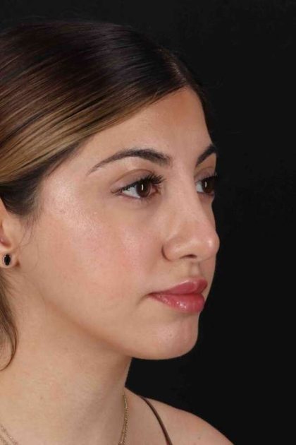 Rhinoplasty Before & After Patient #3214