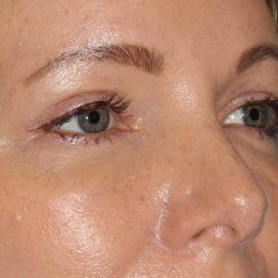 Browlift Before & After Patient #1391