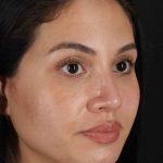 Rhinoplasty Before & After Patient #3236