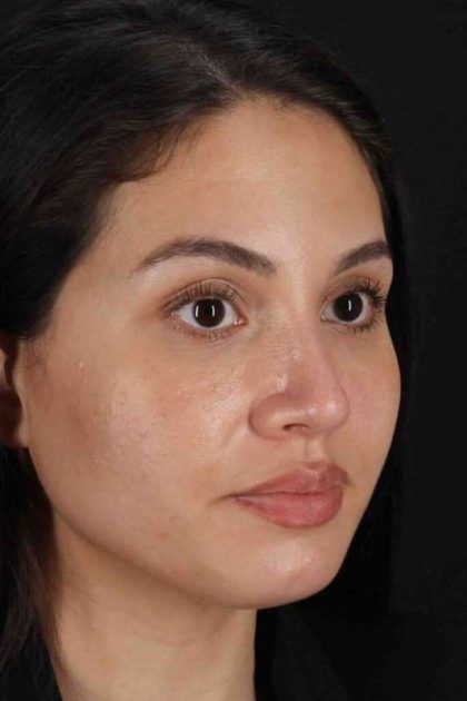 Rhinoplasty Before & After Patient #3236