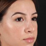 Rhinoplasty Before & After Patient #3247