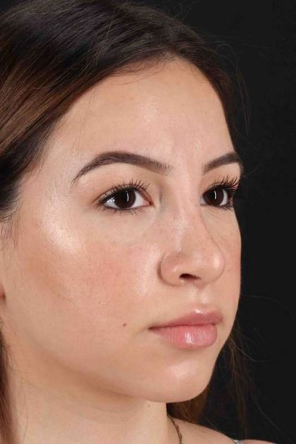 Rhinoplasty Before & After Patient #3247