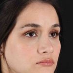 Rhinoplasty Before & After Patient #3258