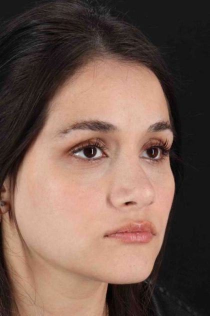 Rhinoplasty Before & After Patient #3258