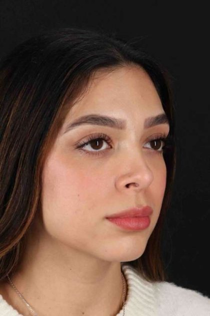 Rhinoplasty Before & After Patient #3269