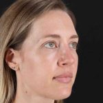 Rhinoplasty Before & After Patient #3291