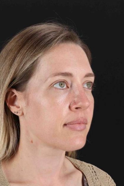 Rhinoplasty Before & After Patient #3291