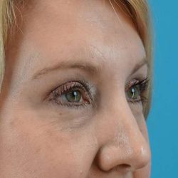 Browlift Before & After Patient #1402