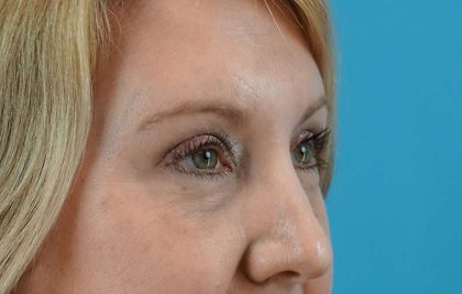 Browlift Before & After Patient #1402