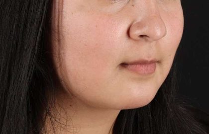 Submental Liposuction Before & After Patient #3412