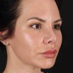Buccal Fat Pad Before & After Patient #1425