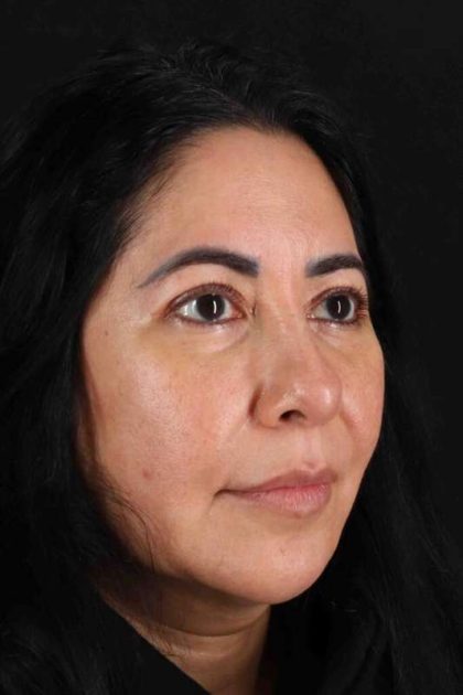Upper Blepharoplasty Before & After Patient #3456