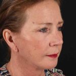 Upper Blepharoplasty Before & After Patient #3478
