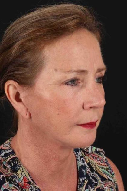 Upper Blepharoplasty Before & After Patient #3478