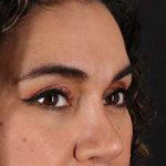 Upper Blepharoplasty Before & After Patient #3522