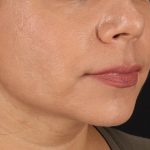 Facelift Before & After Patient #3555