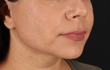 Facelift Before & After Patient #3555