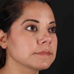Buccal Fat Pad Before & After Patient #1436