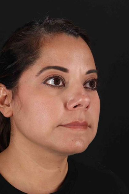 Buccal Fat Pad Before & After Patient #1436