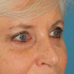 Lower Blepharoplasty Before & After Patient #2419