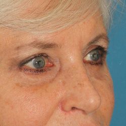 Lower Blepharoplasty Before & After Patient #2419