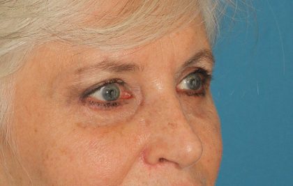 Upper Blepharoplasty Before & After Patient #3532