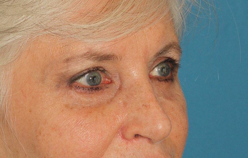 Upper Blepharoplasty Before & After Patient #3532