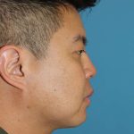 Buccal Fat Pad Before & After Patient #1474