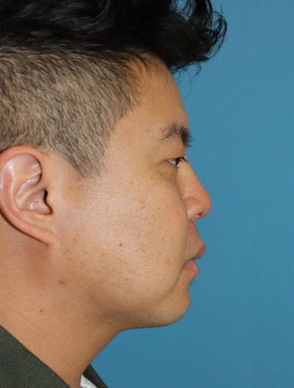 Buccal Fat Pad Before & After Patient #1474