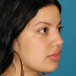 Buccal Fat Pad Before & After Patient #1485