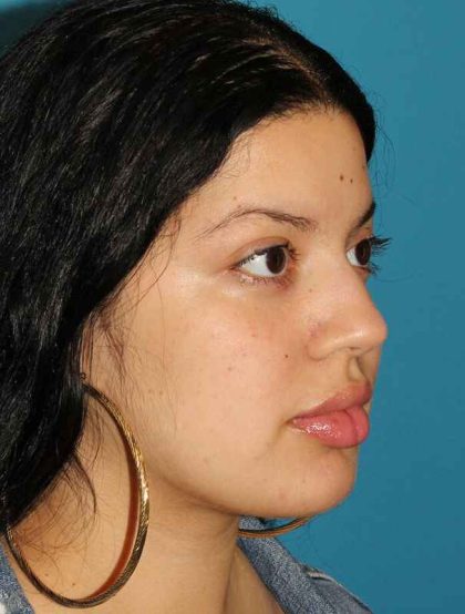 Buccal Fat Pad Before & After Patient #1485