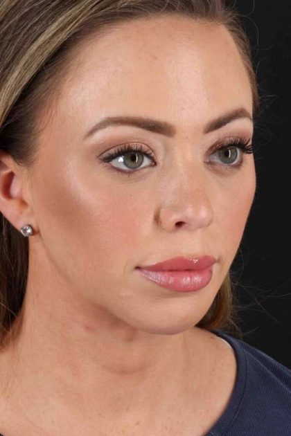 Chin Implant Before & After Patient #1518