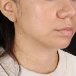 Chin Implant Before & After Patient #1540
