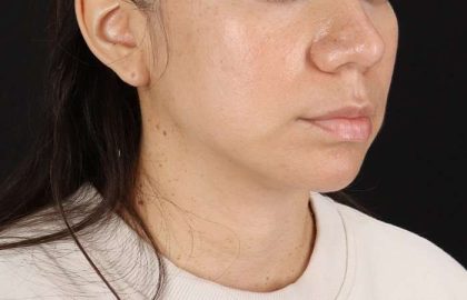 Chin Implant Before & After Patient #1540