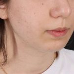 Chin Implant Before & After Patient #1551