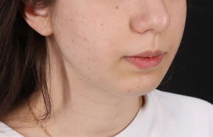 Chin Implant Before & After Patient #1551