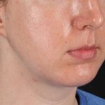 Chin Implant Before & After Patient #1562