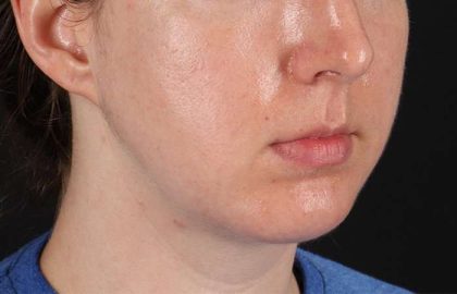 Chin Implant Before & After Patient #1562