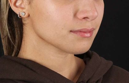 Chin Implant Before & After Patient #1573