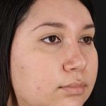 Chin Implant Before & After Patient #1604