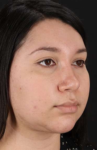Chin Implant Before & After Patient #1604