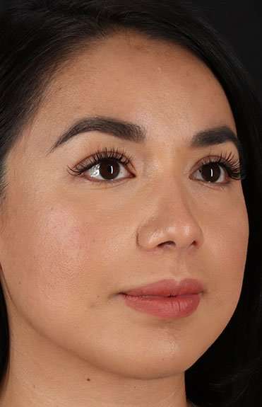 Chin Implant Before & After Patient #1626