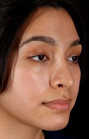 Chin Implant Before & After Patient #1637