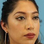 Chin Implant Before & After Patient #1670