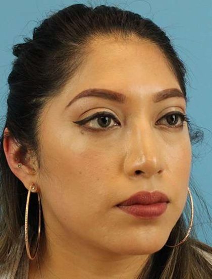 Chin Implant Before & After Patient #1670