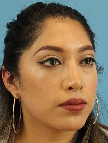 Chin Implant Before & After Patient #1670